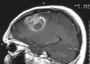 Celldex glioblastoma vaccine extends survival in Phase II - FierceVaccines