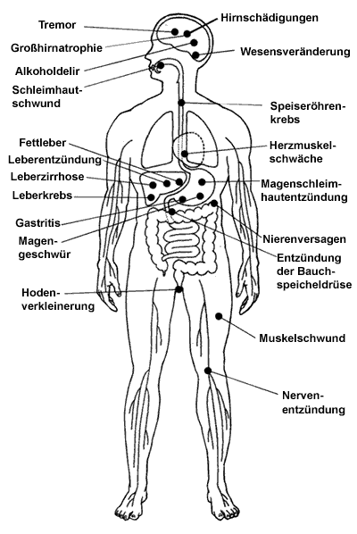 Schaubild_-_Alkoholschäden.gif