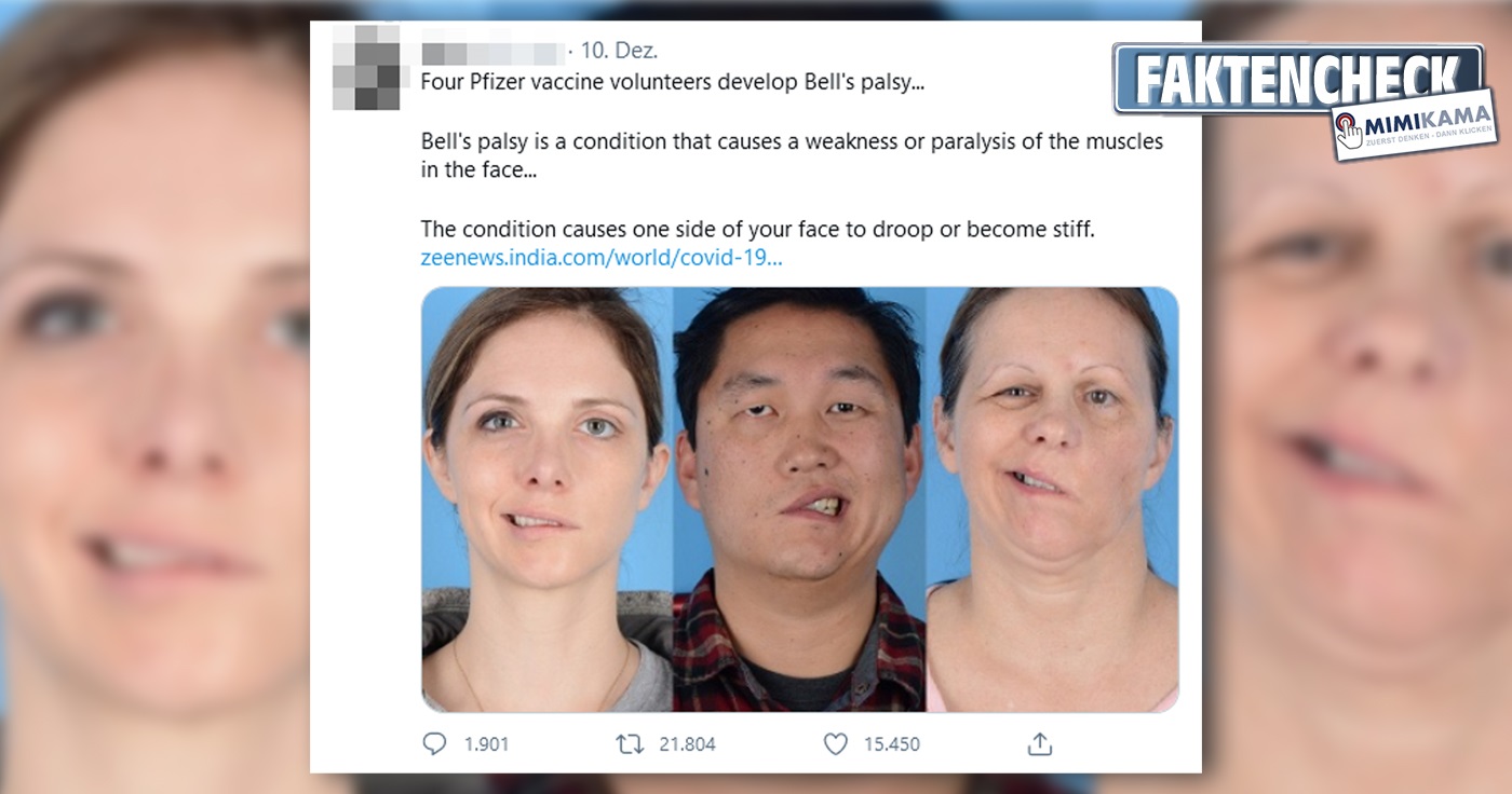 bellspalsy.jpg