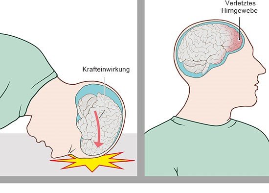 de_gehirnerschuetterung_verletzungsmechanismu....jpg