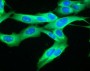 Immuno-oncology combo trials in melanoma announced